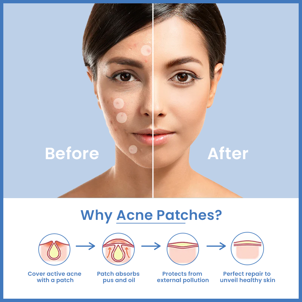 Loom Heavens Invisible Spot Shield- 72 Hydrocolloid Pimple Patches with Salicylic Acid & Camellia Leaf's Extract.