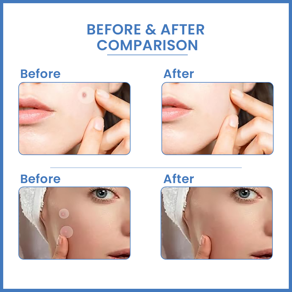 Loom Heavens Invisible Spot Shield- 72 Hydrocolloid Pimple Patches with Salicylic Acid & Camellia Leaf's Extract.